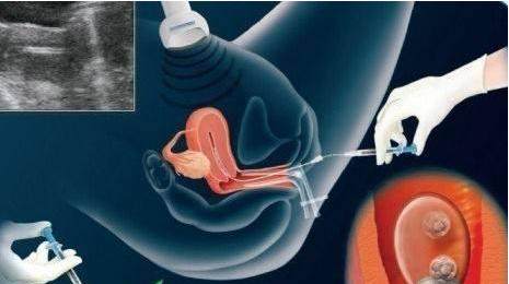 好孕案例